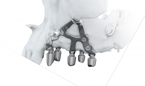 Implantologia iuxta-ossea con l’IMPIANTO SUBPERIOSTALE