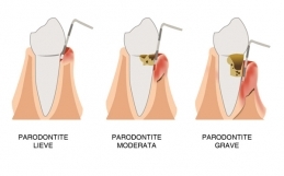 Parodontite: come si cura?