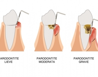 Parodontite: come si cura?