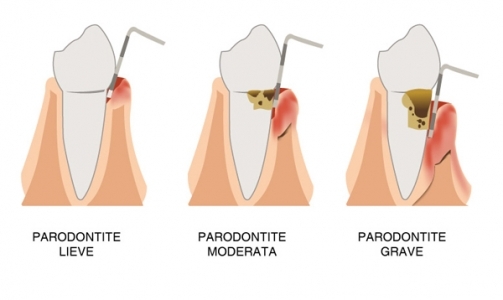 Parodontite: come si cura?