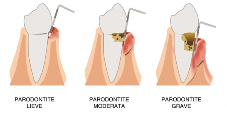 Parodontite: come si cura?