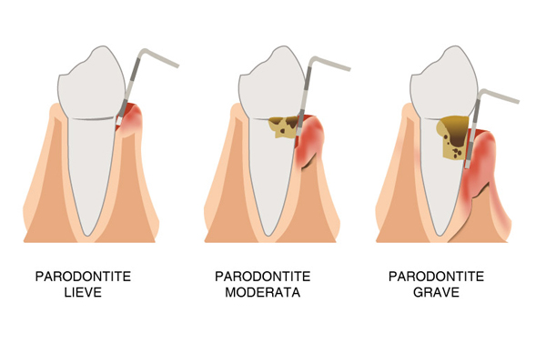 Parodontite: come si cura?